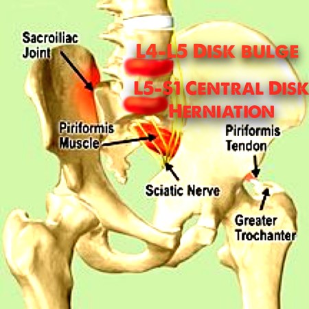 What a pain in the butt!